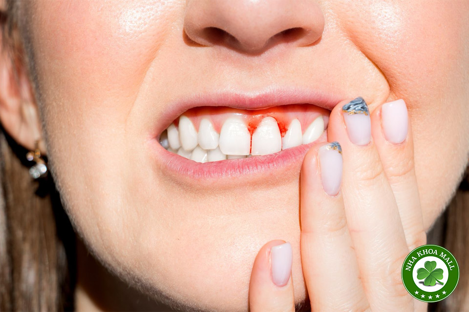 Viêm nha chu nặng sẽ gia tăng đến năm 2050: Cảnh báo từ nghiên cứu mới của JADA