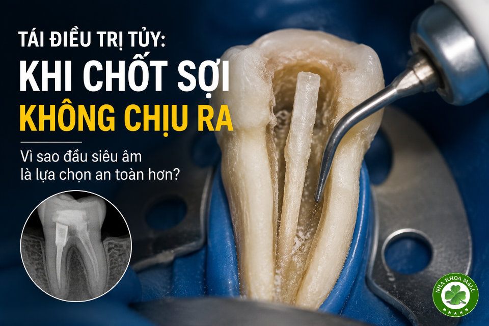 Điều trị tủy lại: xử lý thế nào khi chốt sợi không chịu ra?