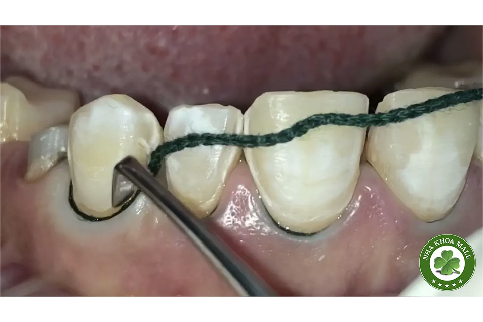 Chỉ co nướu SURE-Cord - Giải pháp tối ưu trong quản lý mô nướu trước lấy dấu và phục hình