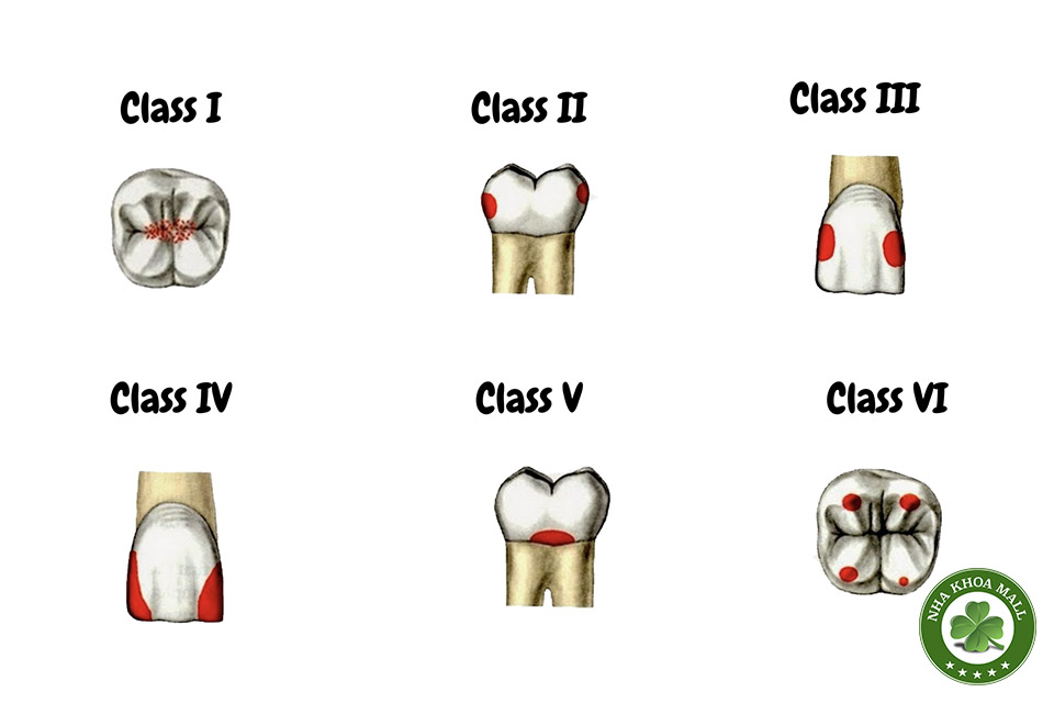Phân loại các loại xoang trám theo g.v. black trong nha khoa hiện đại