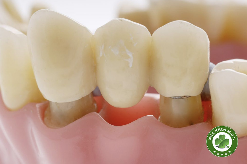 Các loại vật liệu làm răng tạm nha khoa: Ưu nhược điểm và cách lựa chọn