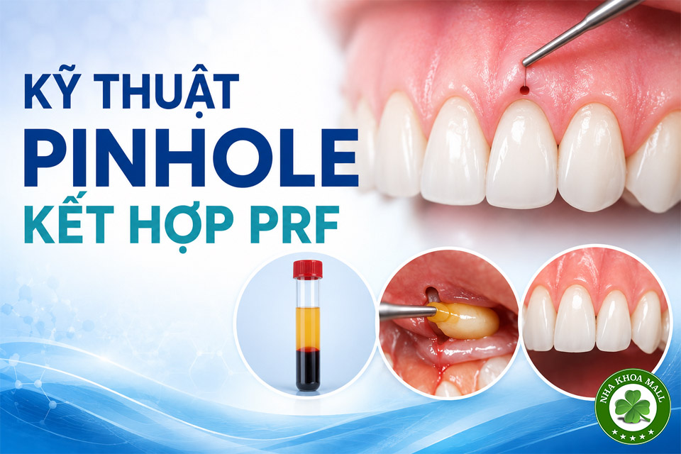 Kỹ thuật phẫu thuật Pinhole kết hợp fibrin giàu tiểu cầu (PRF) nhằm tăng cường ghép mô mềm