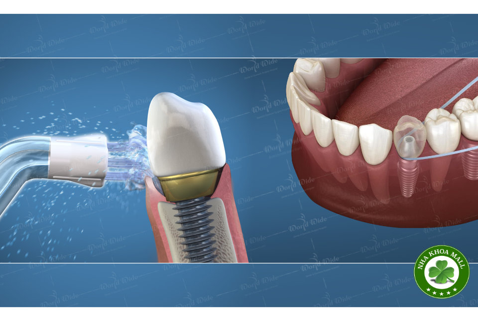 Tầm Quan Trọng Của Chăm Sóc Răng Sau Khi Đã Cấy Ghép Implant