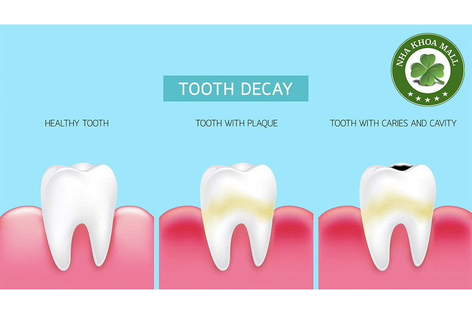 Sâu răng: Nguyên nhân, dấu hiệu và cách điều trị