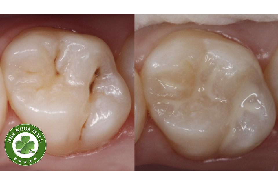 Vật liệu trám răng GIC: Bí quyết bảo vệ răng hiệu quả và thẩm mỹ hoàn hảo