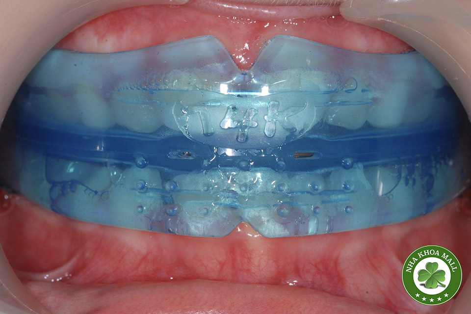 Hàm Trainer T4K – Bí quyết chỉnh nha sớm giúp trẻ tự tin và khỏe mạnh