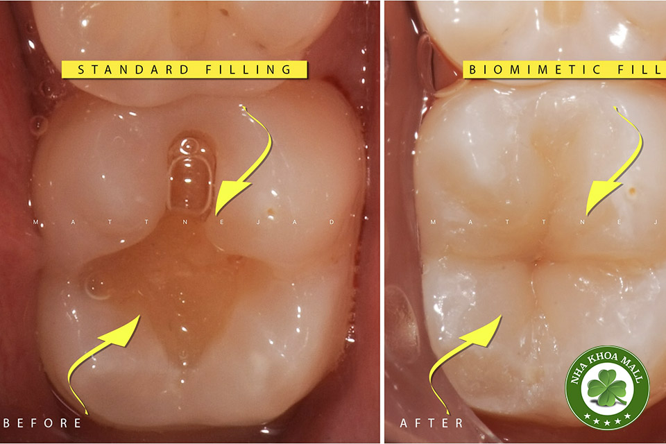 Xi măng trám răng: Khám phá bí quyết giúp tăng độ bền, bảo vệ răng tối ưu