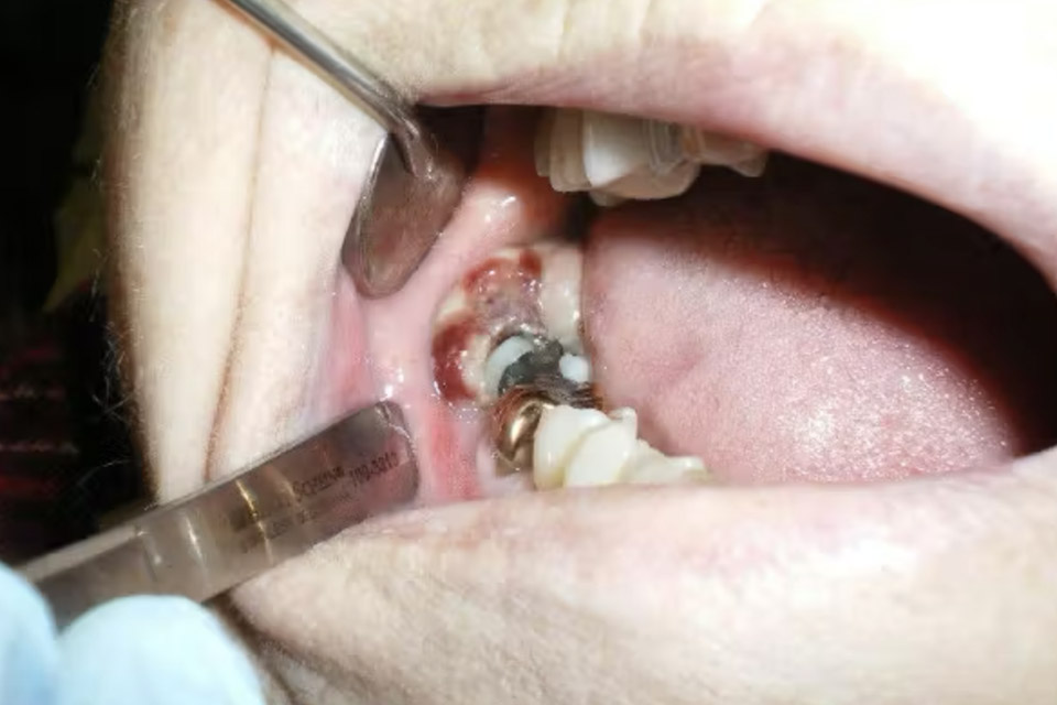 Case lâm sàng bệnh lý miệng với tiền sử y khoa phức tạp