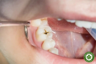 Can thiệp sớm trong sâu răng: Tại sao một tổn thương nhỏ lại là vấn đề lớn?