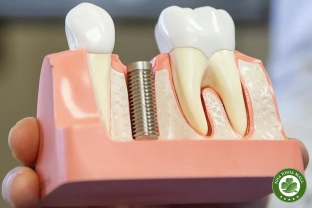 Mẫu Hàm Tư Vấn Implant: Công Cụ Trực Quan Giúp Bác Sĩ Nâng Cao Hiệu Quả Tư Vấn