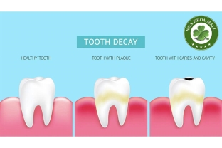 Sâu răng: Nguyên nhân, dấu hiệu và cách điều trị