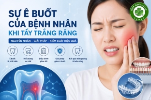 Sự Ê Buốt Của Bệnh Nhân Khi Tẩy Trắng Răng: Giải Pháp Kiểm Soát Hiệu Quả