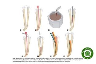 Một số lưu ý khi dùng Naocl 5,25% để khử khuẩn Cone gutta percha trước khi ốp