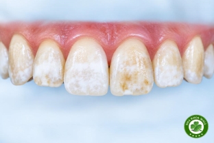 Sự thay đổi màu sắc răng bị nhiễm fluor: Nguyên nhân, dấu hiệu và cách khắc phục