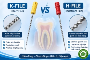 K-file và H-file trong nội nha: So sánh cấu tạo, cơ chế cắt và cách lựa chọn