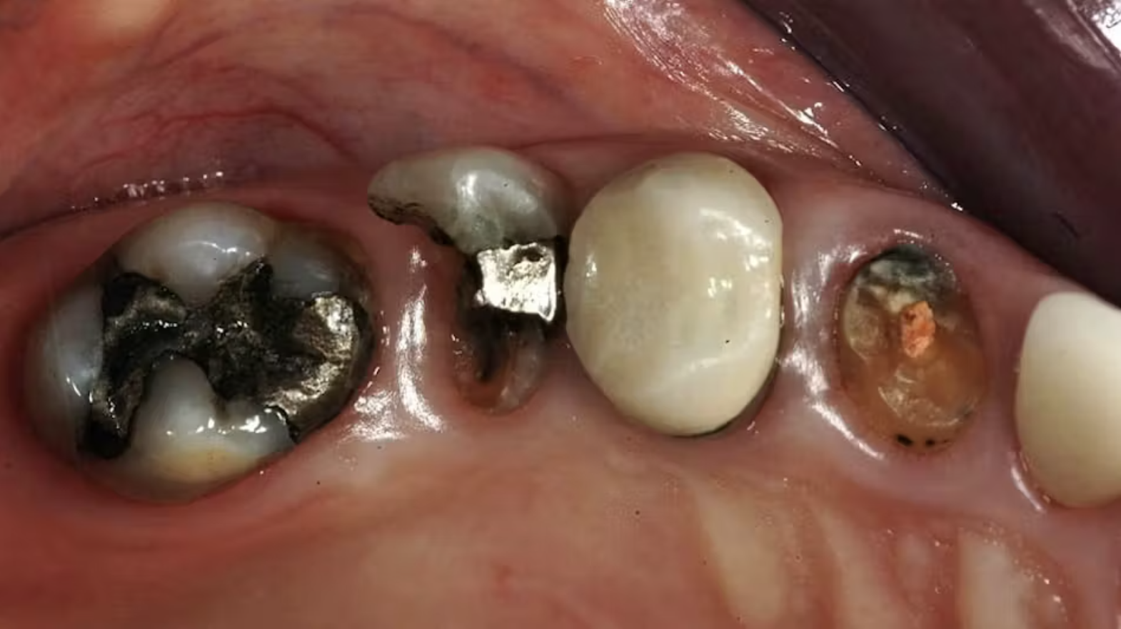 Bảo tồn răng thật tối đa: Nguyên tắc điều trị trước khi nghĩ đến implant và răng sứ