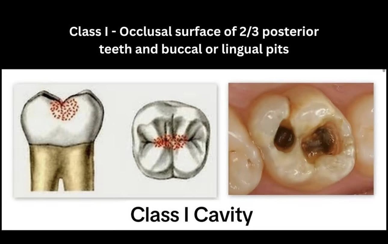 Phân loại các loại xoang trám theo g.v. black🌱NHA KHOA MALL🌱