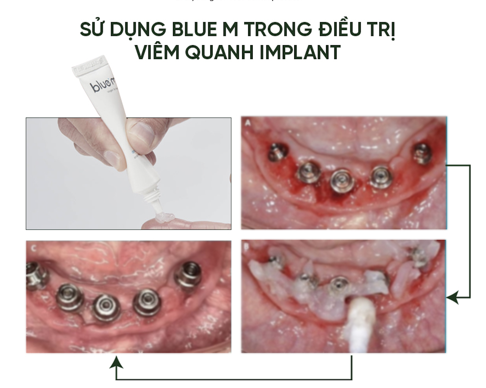 Gel lành thương🌱cho Implant Blue M Oral Gel Hà Lan GIÁ TỐT🌱NHA KHOA MALL🌱