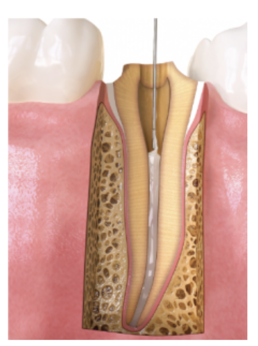 Trám bít ống tủy🌱Bioceramic Root Canal Sealer MTApex Ultradent GIÁ TỐT🌱NHA KHOA MALL🌱