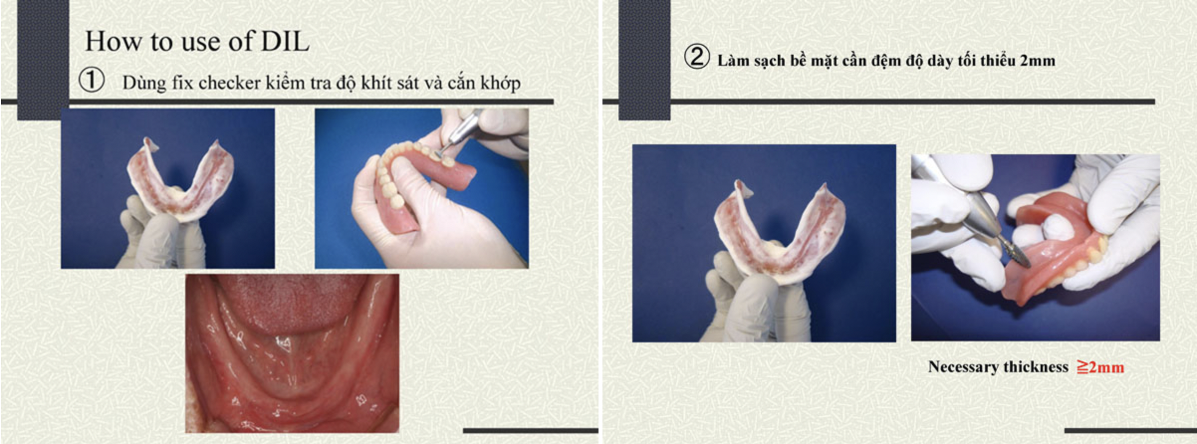 BỘ LỚN - Vật liệu đệm hàm giả tháo lắp DIL - KAMEMIZU CHEMICAL - Nhật Bản