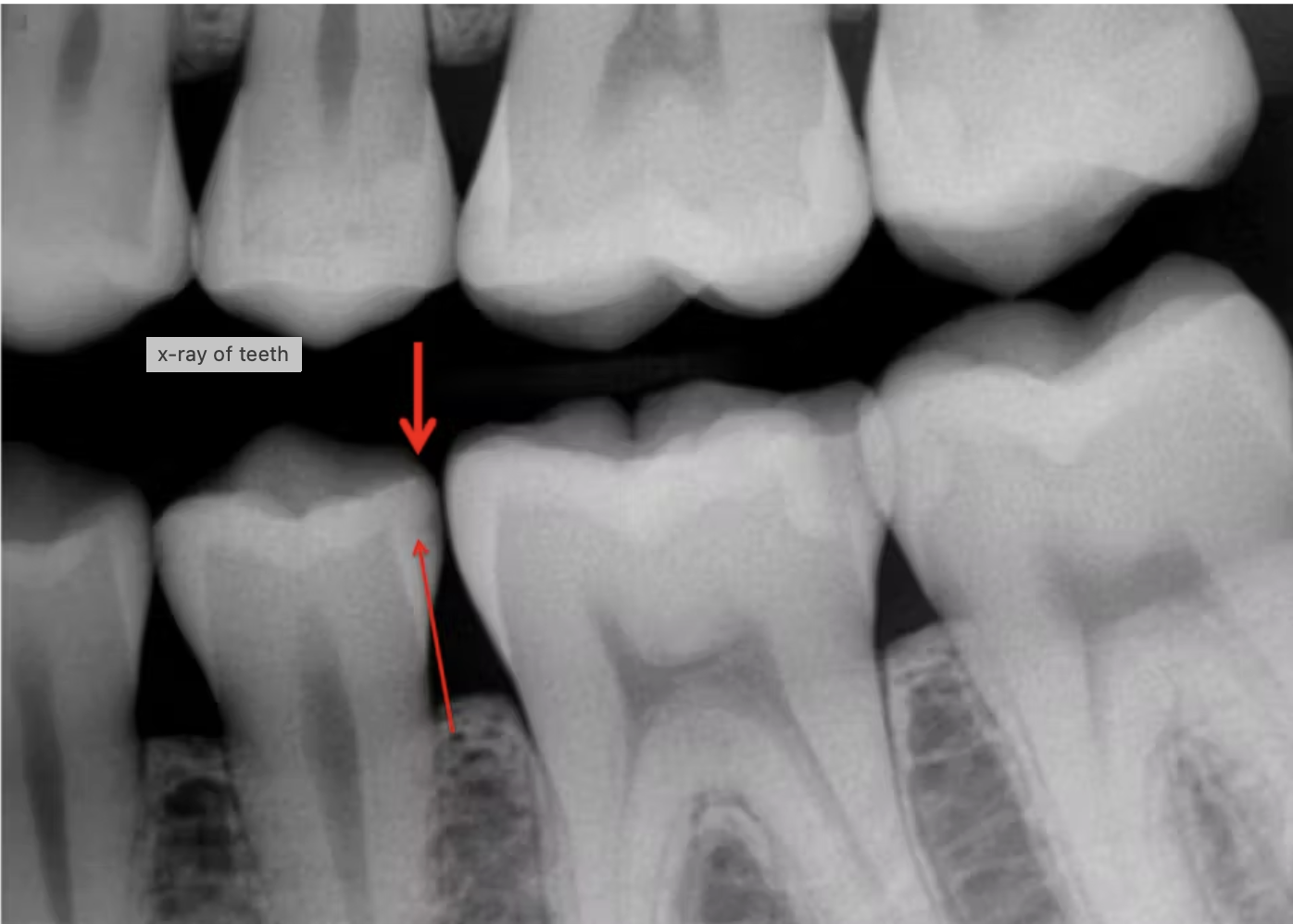 Các quy trình tốt nhất🌱cho việc chuẩn bị răng để trám composite GIÁ TỐT🌱NHA KHOA MALL🌱