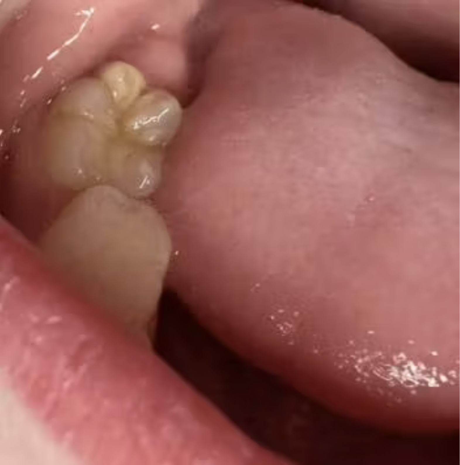 sdf-co-gay-nhuom-den-khi-co-tinh-trang-thieu-khoang-rang-mih