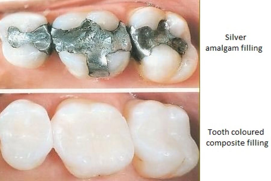 Trám răng bằng Amalgam🌱có nguy hiểm không? 5 điều bạn cần biết trước khi quyết định🌱NHA KHOA MALL🌱