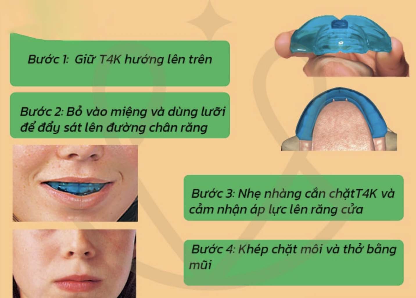 Hàm Trainer T4K🌱Bí quyết chỉnh nha sớm giúp trẻ tự tin và khỏe mạnh🌱NHA KHOA MALL🌱