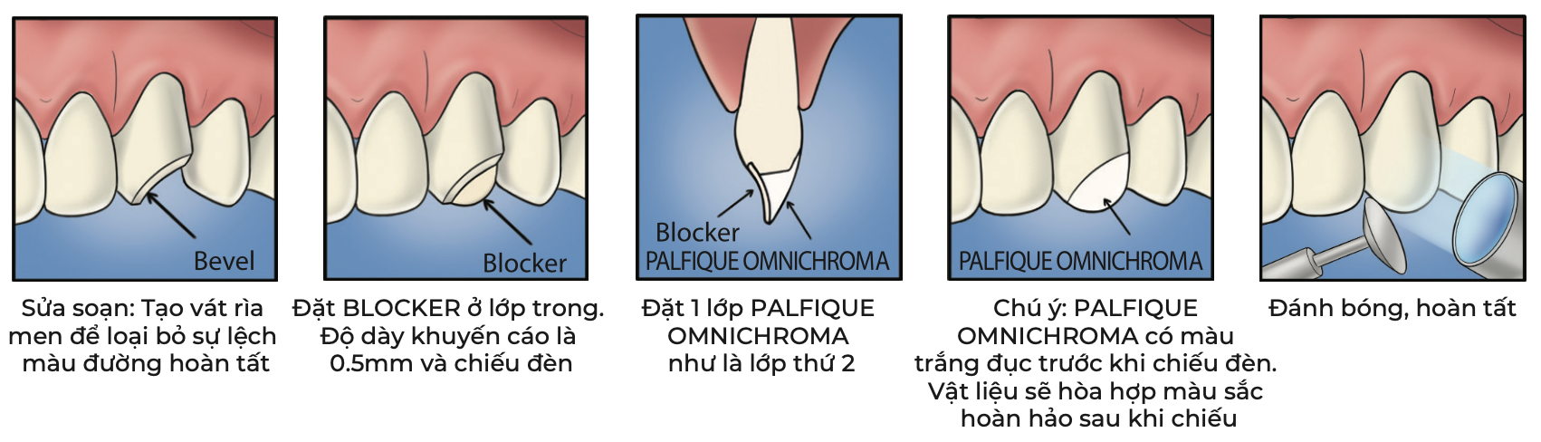 Composite lỏng che màu trám lót🌱OMNICHROMA BLOCKER FLOW GIÁ TỐT🌱NHA KHOA MALL🌱