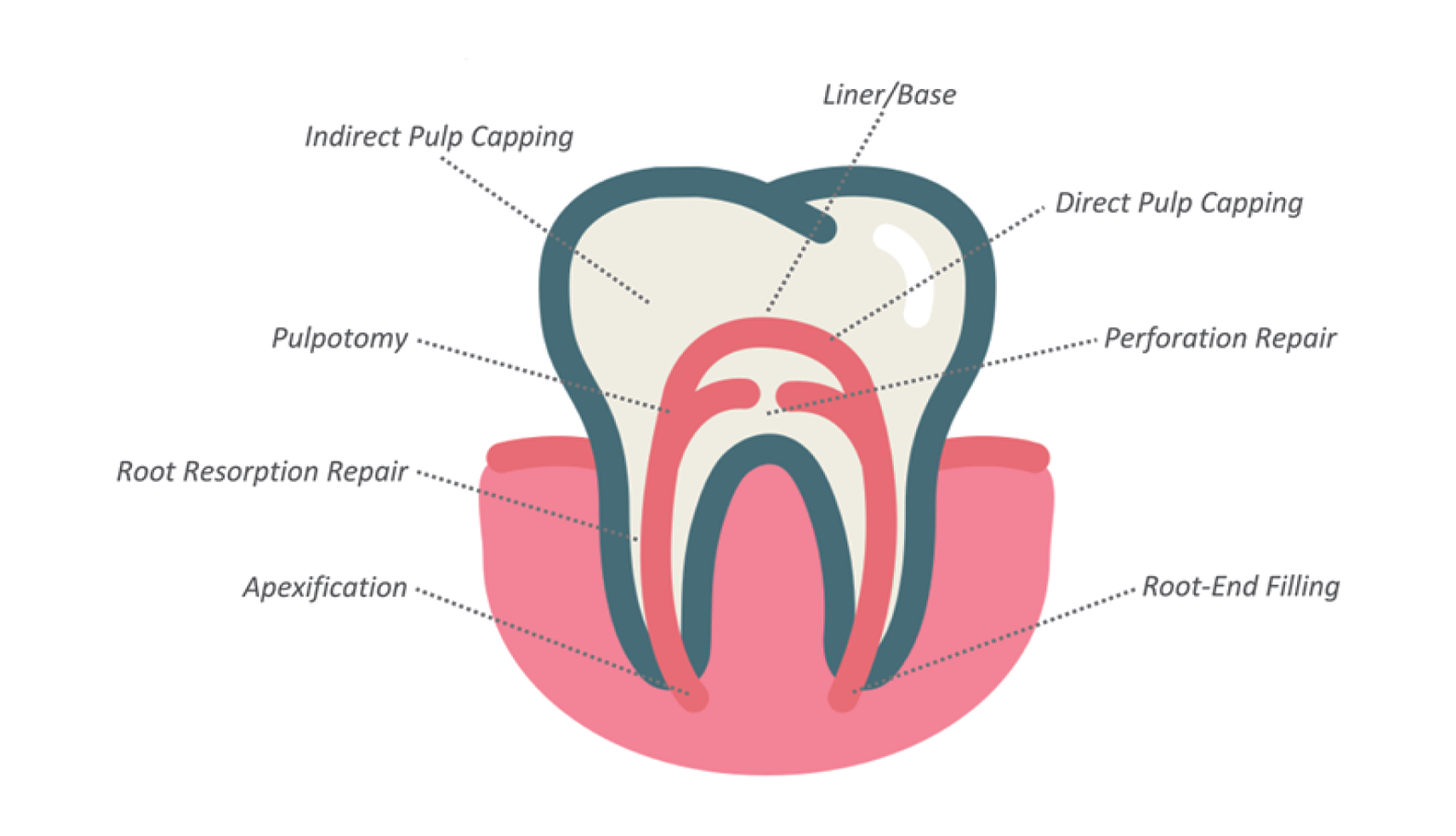 Xi măng trám bít ống tuỷ🌱CeraPutty Meta Biomed Hàn Quốc GIÁ TỐT🌱NHA KHOA MALL🌱