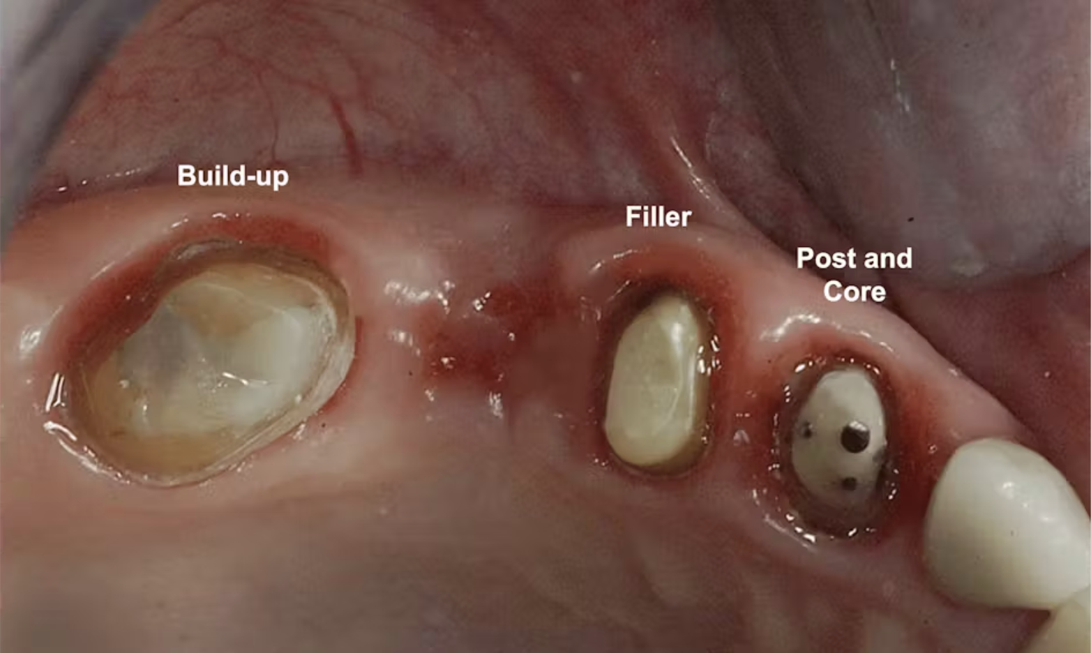 Bảo tồn răng thật tối đa: Nguyên tắc điều trị trước khi nghĩ đến implant