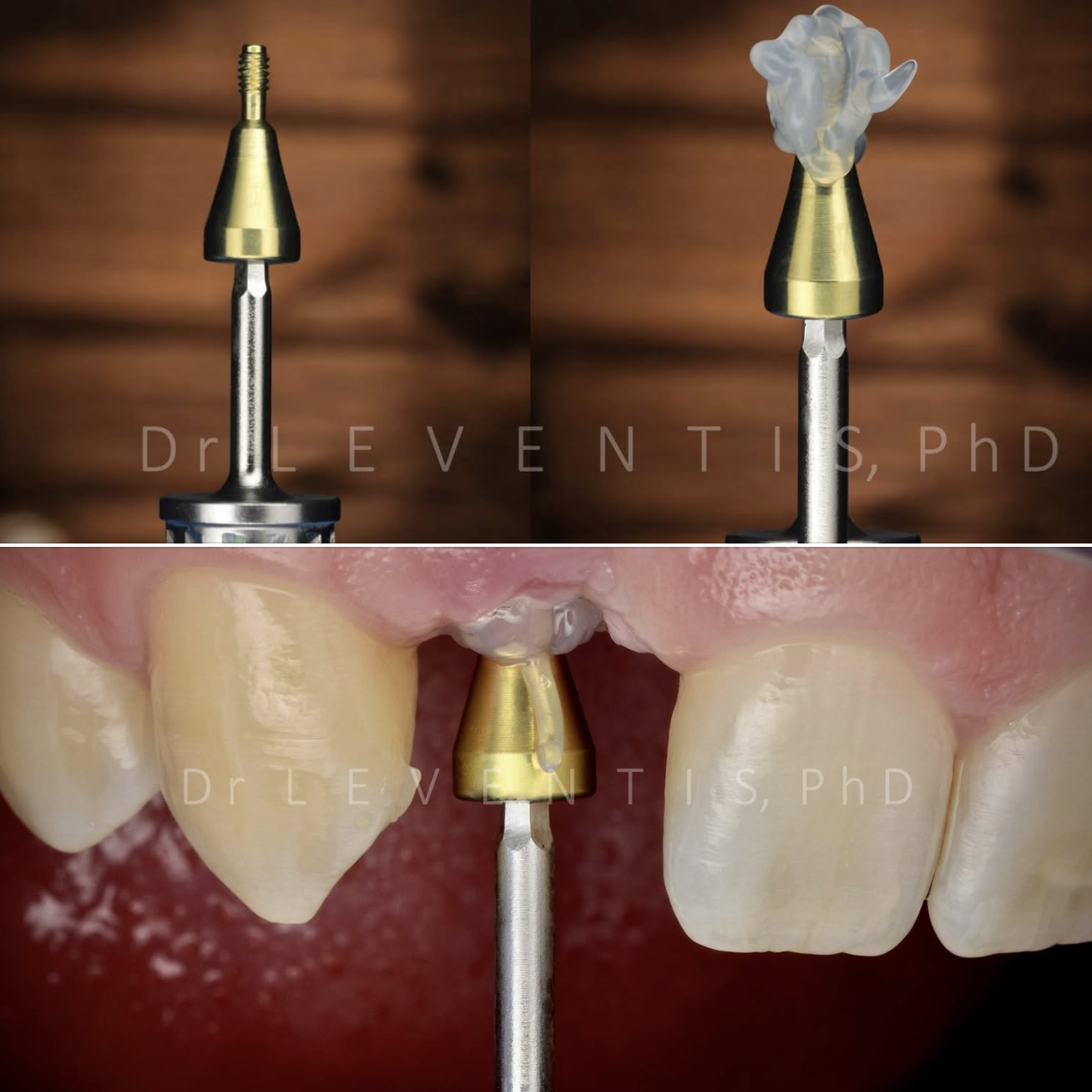 Gel lành thương🌱cho Implant Blue M Oral Gel Hà Lan GIÁ TỐT🌱NHA KHOA MALL🌱