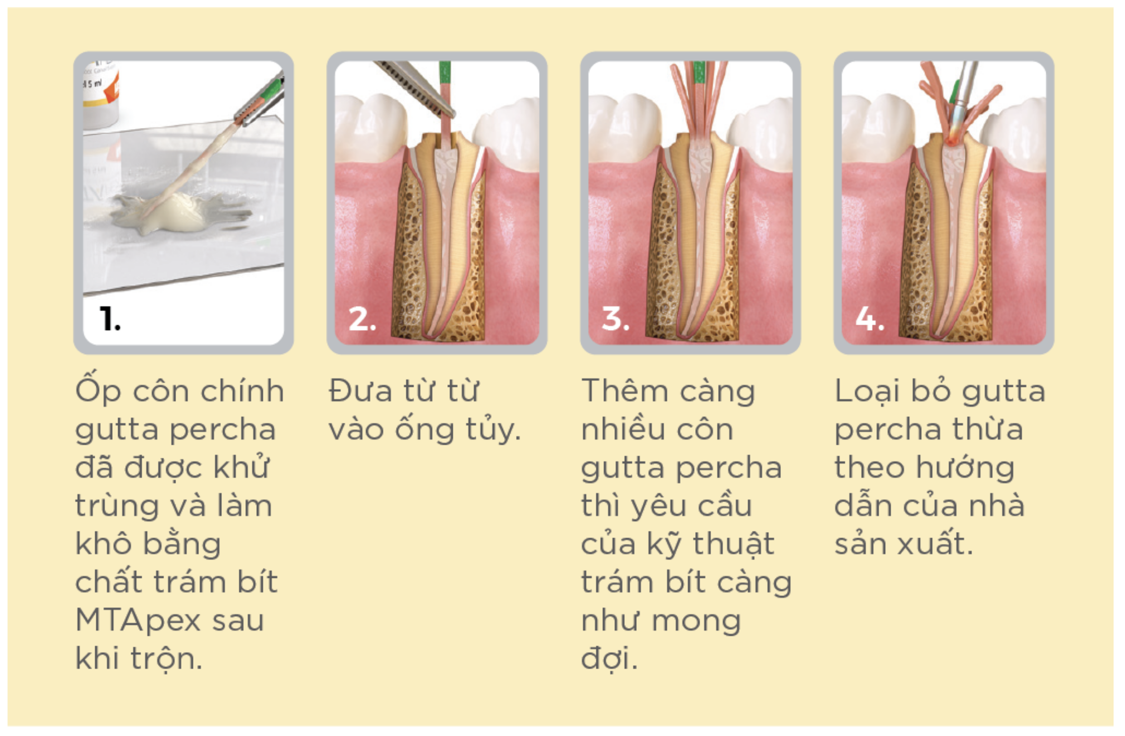 Trám bít ống tủy🌱Bioceramic Root Canal Sealer MTApex Ultradent GIÁ TỐT🌱NHA KHOA MALL🌱