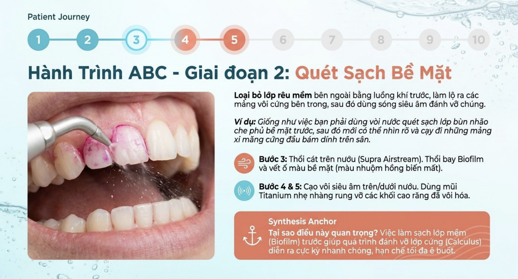 Quy trình ABC và sức mạnh của máy thổi cát Woodpecker PT-A trong chăm sóc răng miệng