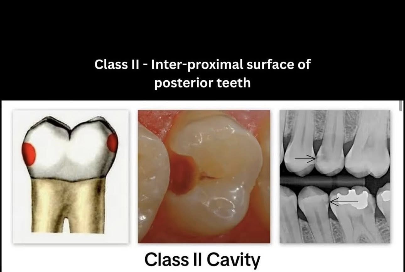 Phân loại các loại xoang trám theo g.v. black🌱NHA KHOA MALL🌱