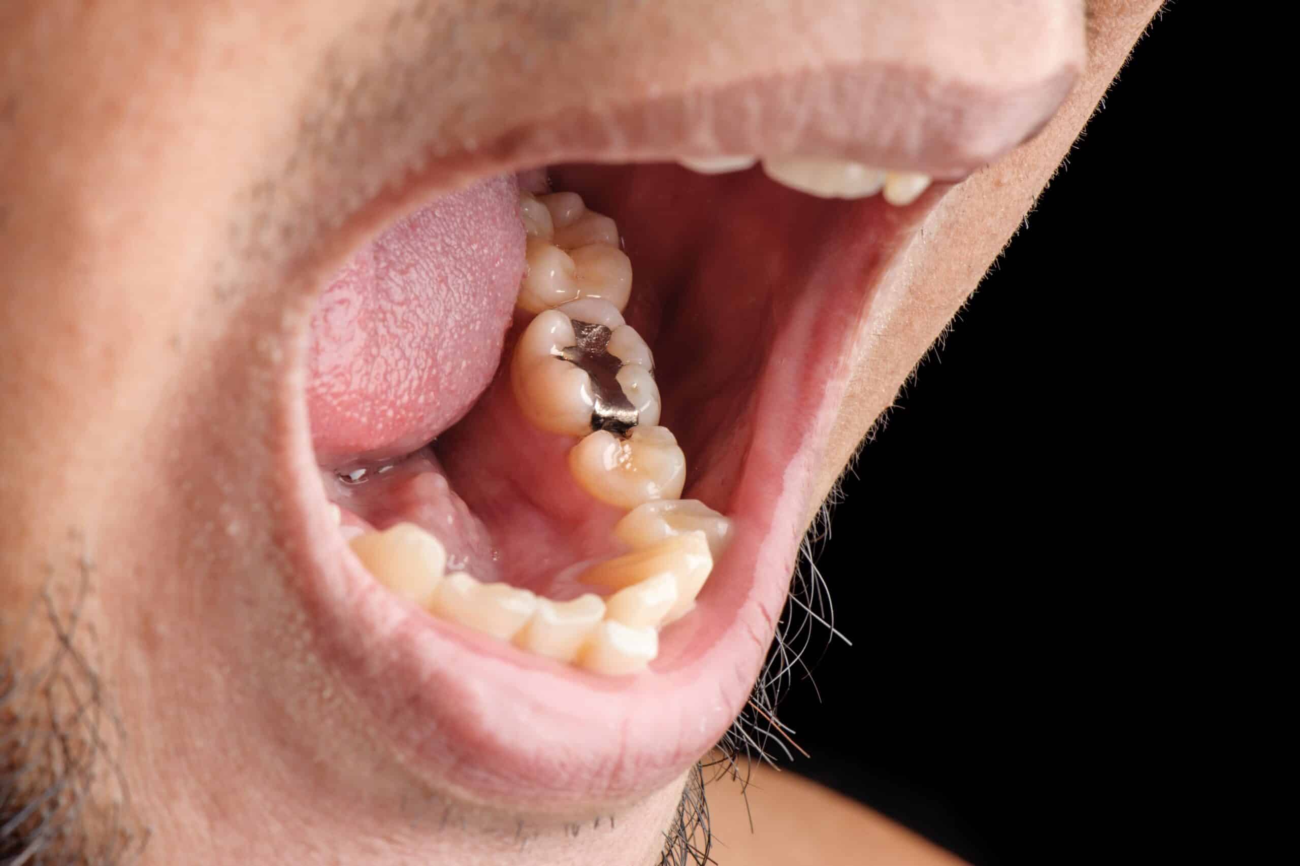 Trám răng bằng Amalgam🌱có nguy hiểm không? 5 điều bạn cần biết trước khi quyết định🌱NHA KHOA MALL🌱