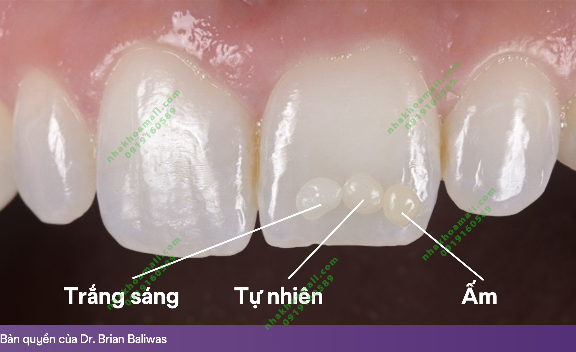 Composite đặc trám răng thẩm mỹ 3M Filtek Easy Match Universal Restorative