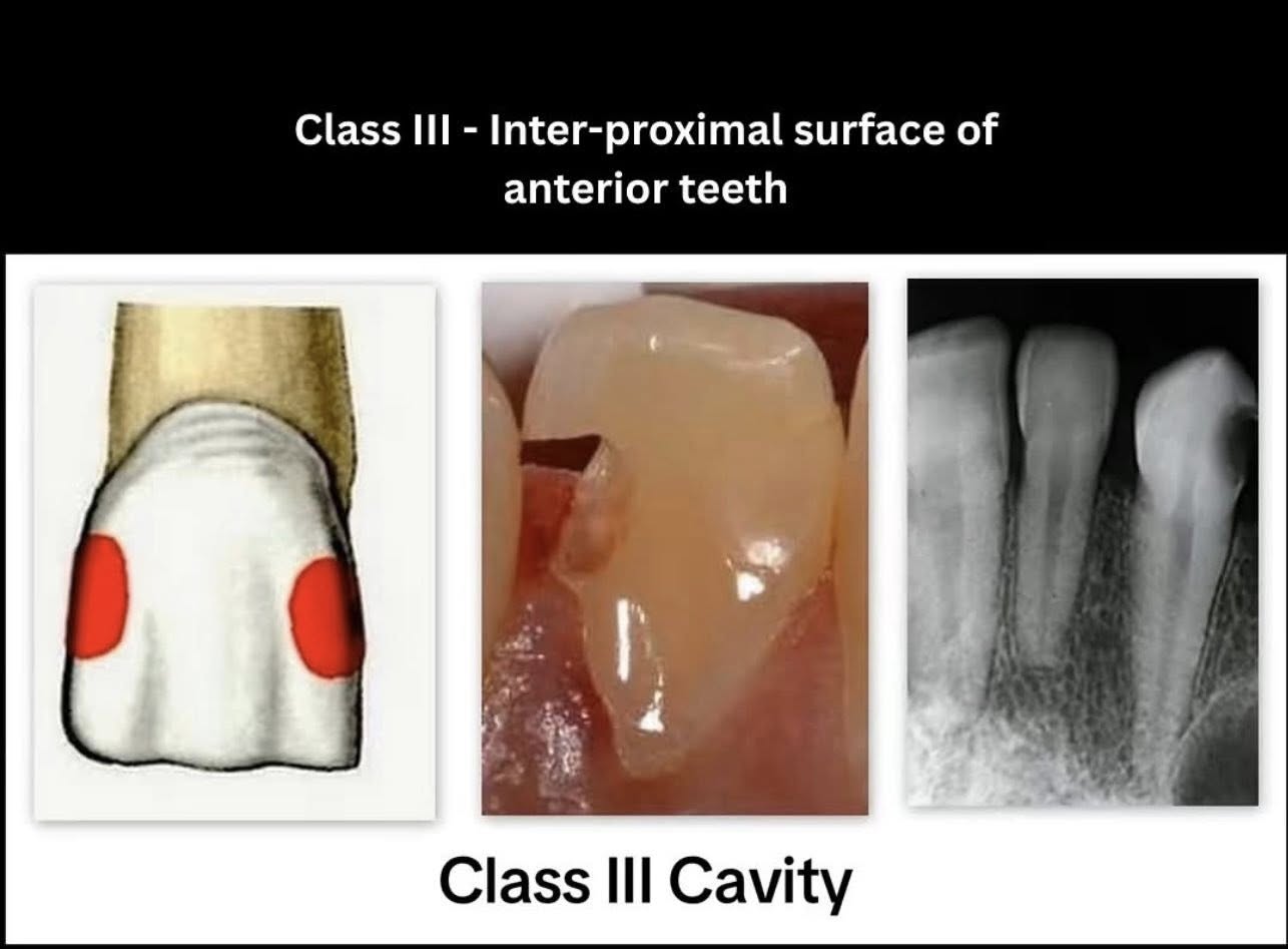 Phân loại các loại xoang trám theo g.v. black🌱NHA KHOA MALL🌱