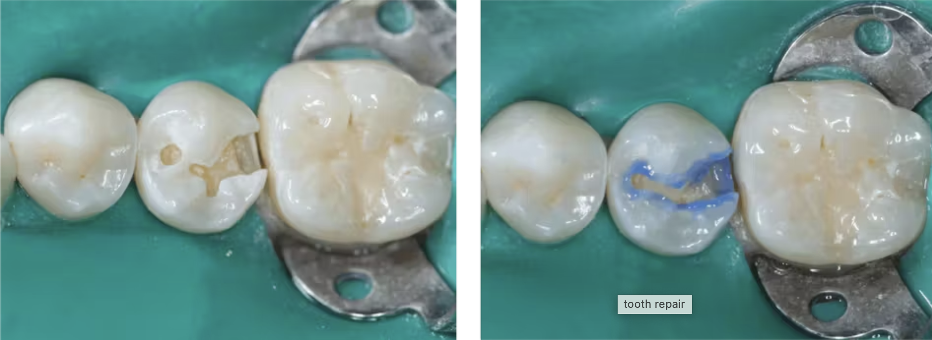 Các quy trình tốt nhất🌱cho việc chuẩn bị răng để trám composite GIÁ TỐT🌱NHA KHOA MALL🌱