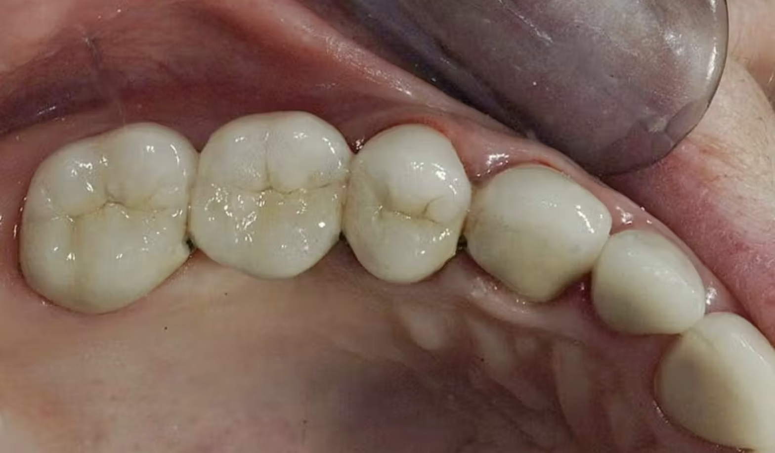 Bảo tồn răng thật tối đa: Nguyên tắc điều trị trước khi nghĩ đến implant