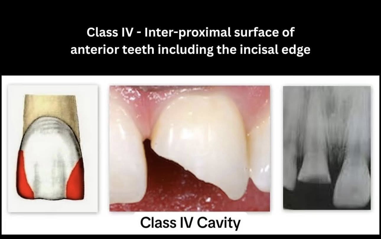 Phân loại các loại xoang trám theo g.v. black🌱NHA KHOA MALL🌱