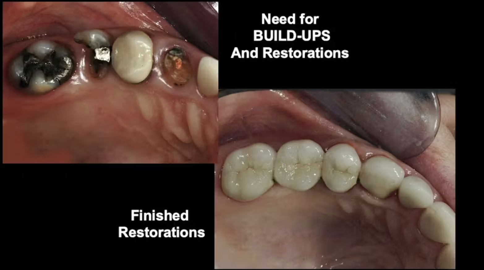 Bảo tồn răng thật tối đa: Nguyên tắc điều trị trước khi nghĩ đến implant