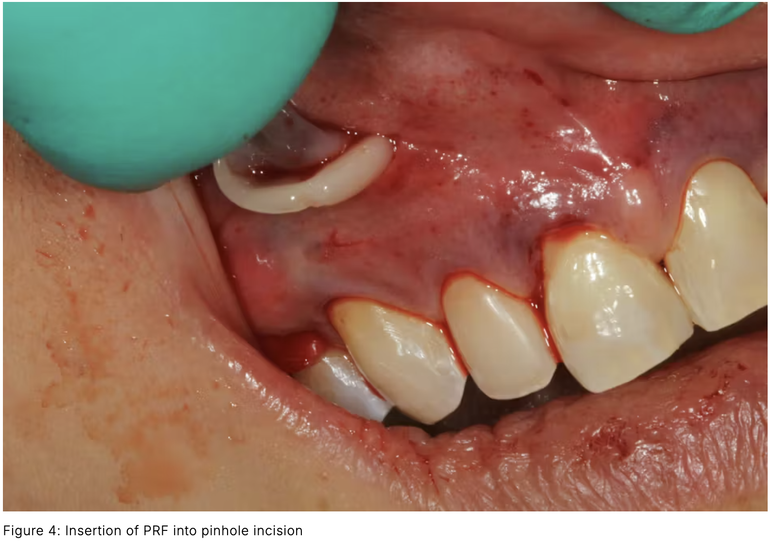 Kỹ thuật phẫu thuật Pinhole🌱kết hợp fibrin giàu tiểu cầu (PRF) nhằm tăng cường ghép mô mềm🌱NHA KHOA MALL🌱