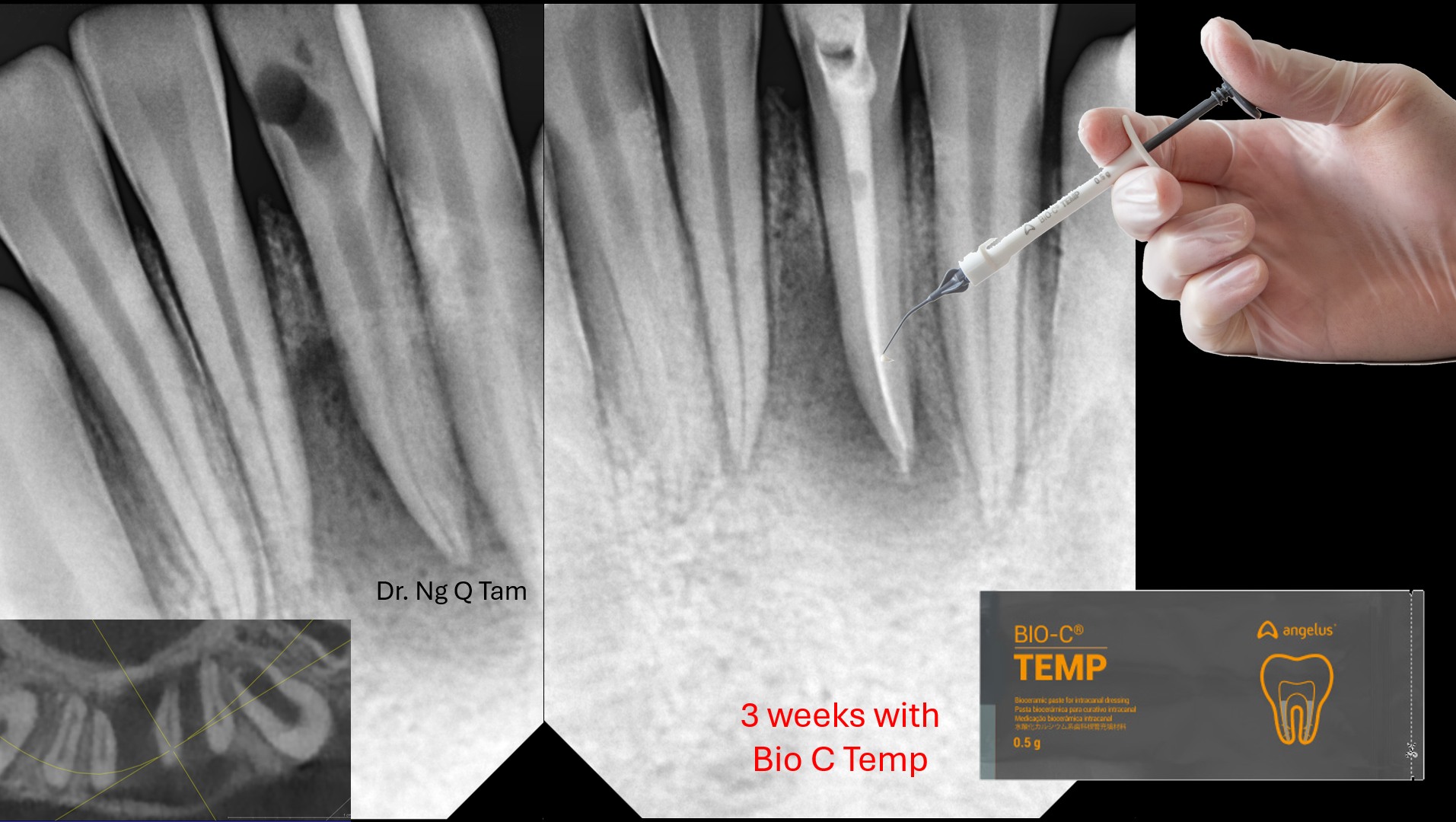 Vật liệu nội nha băng ống tuỷ Bioceramic Bio-C Temp - Angelus 