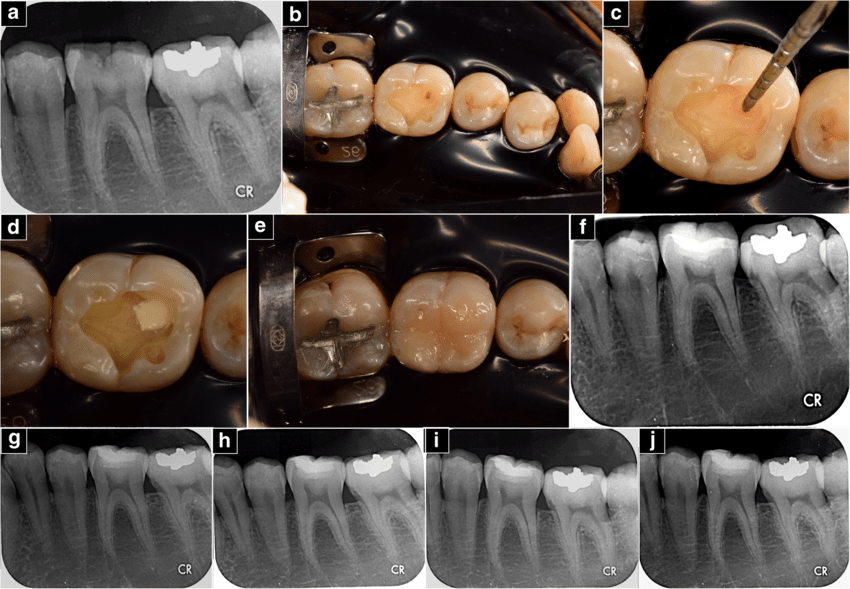 Biodentine🌱trong điều trị nội nha: Cập nhật mới nhất🌱NHA KHOA MALL🌱