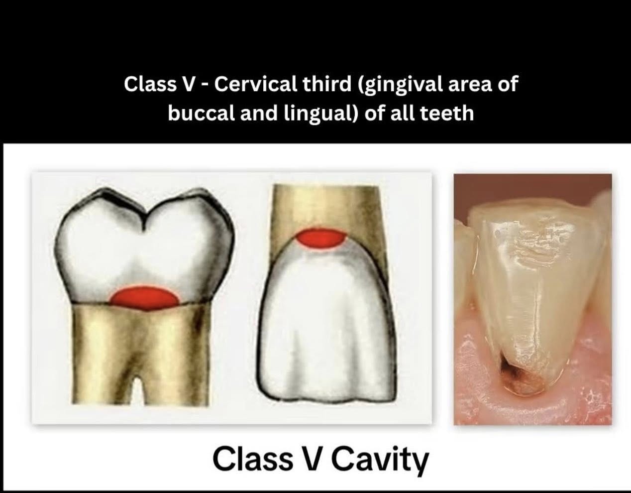 Phân loại các loại xoang trám theo g.v. black🌱NHA KHOA MALL🌱