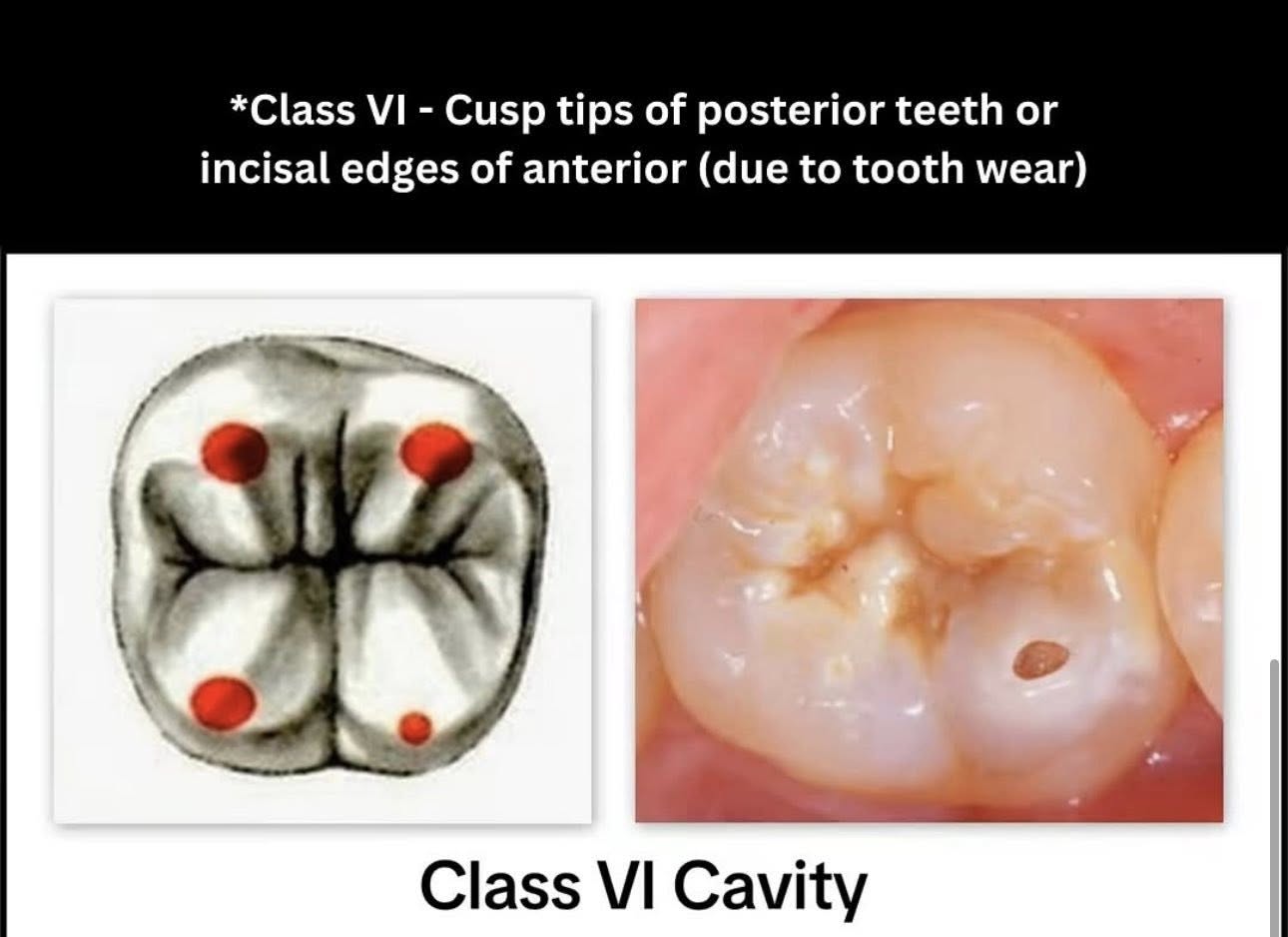 Phân loại các loại xoang trám theo g.v. black🌱NHA KHOA MALL🌱