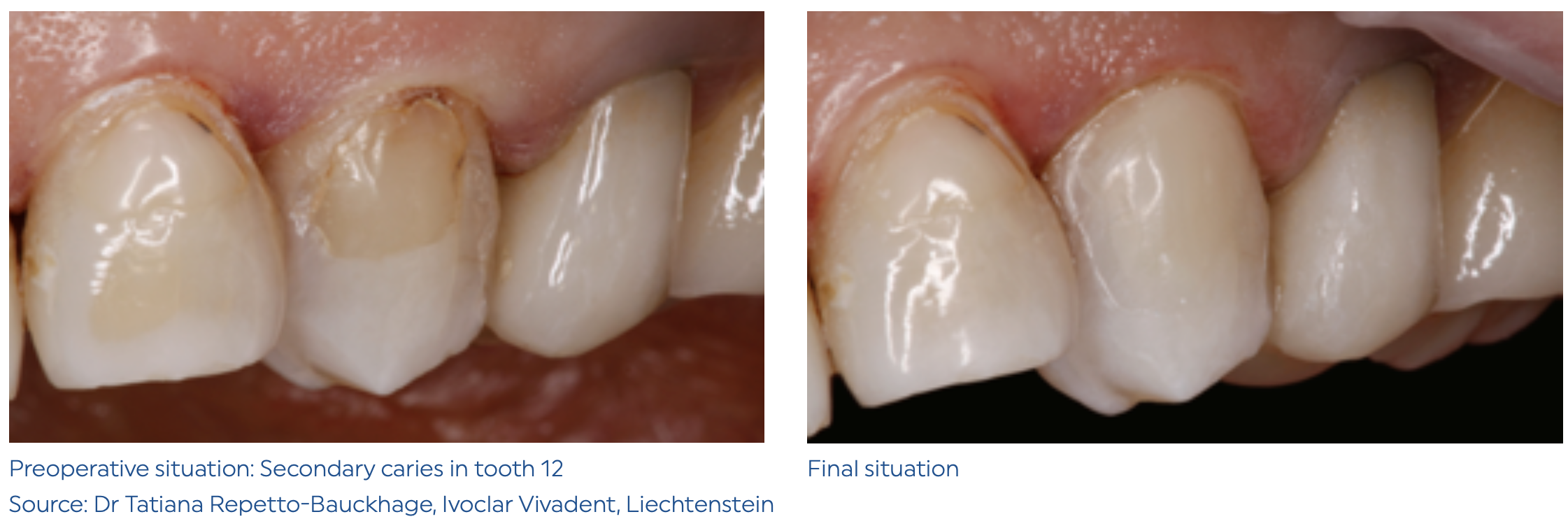 Composite lỏng trám răng TETRIC N-Flow 2 IVOCLAR THẾ HỆ MỚI