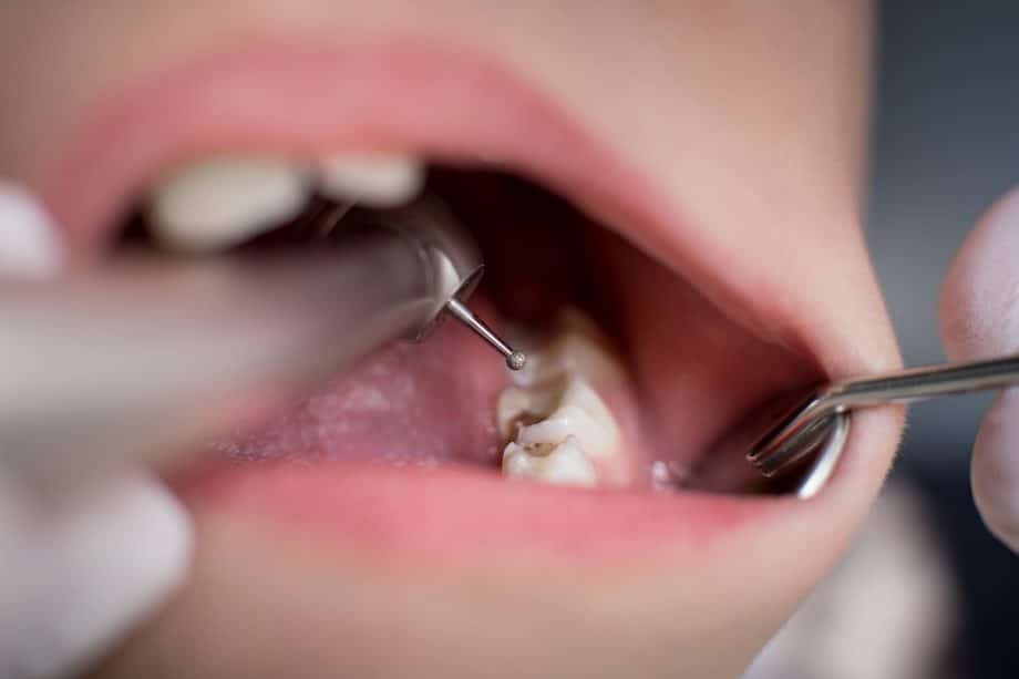 Có nên trám răng sữa cho bé? Giải đáp chi tiết - Cha mẹ không được bỏ qua