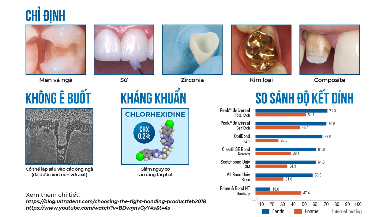 Vật liệu gắn sứ, sửa sứ, veneer Peak Universal Bond Ultradent